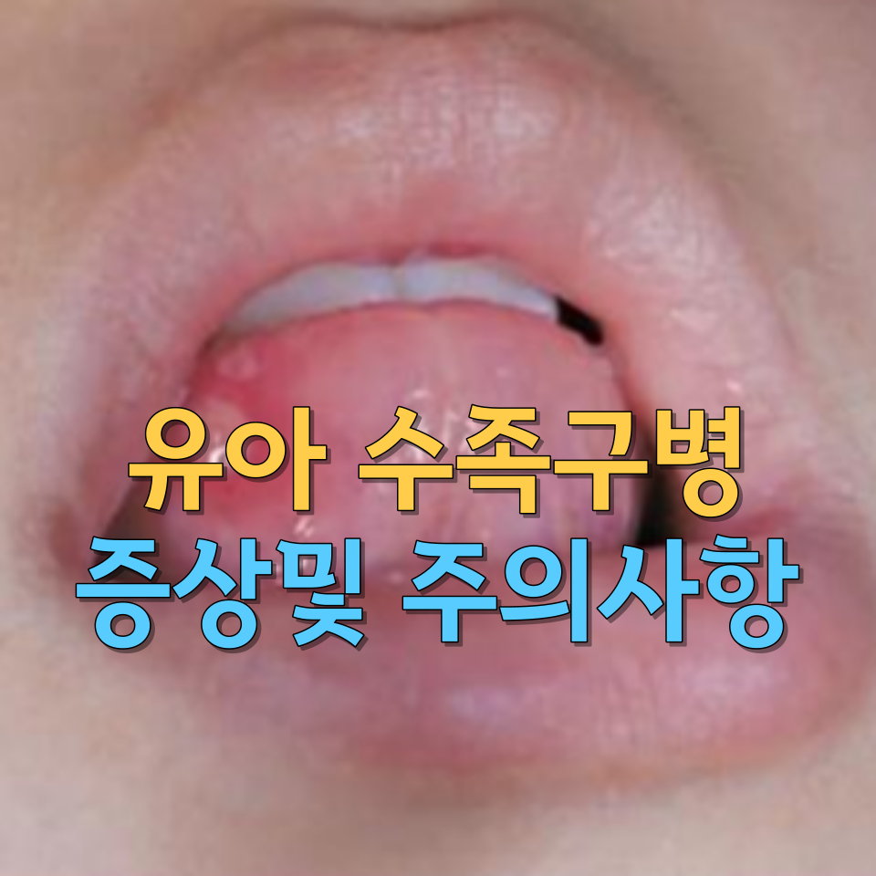  영유아 수족구병 증상 및 주의사항