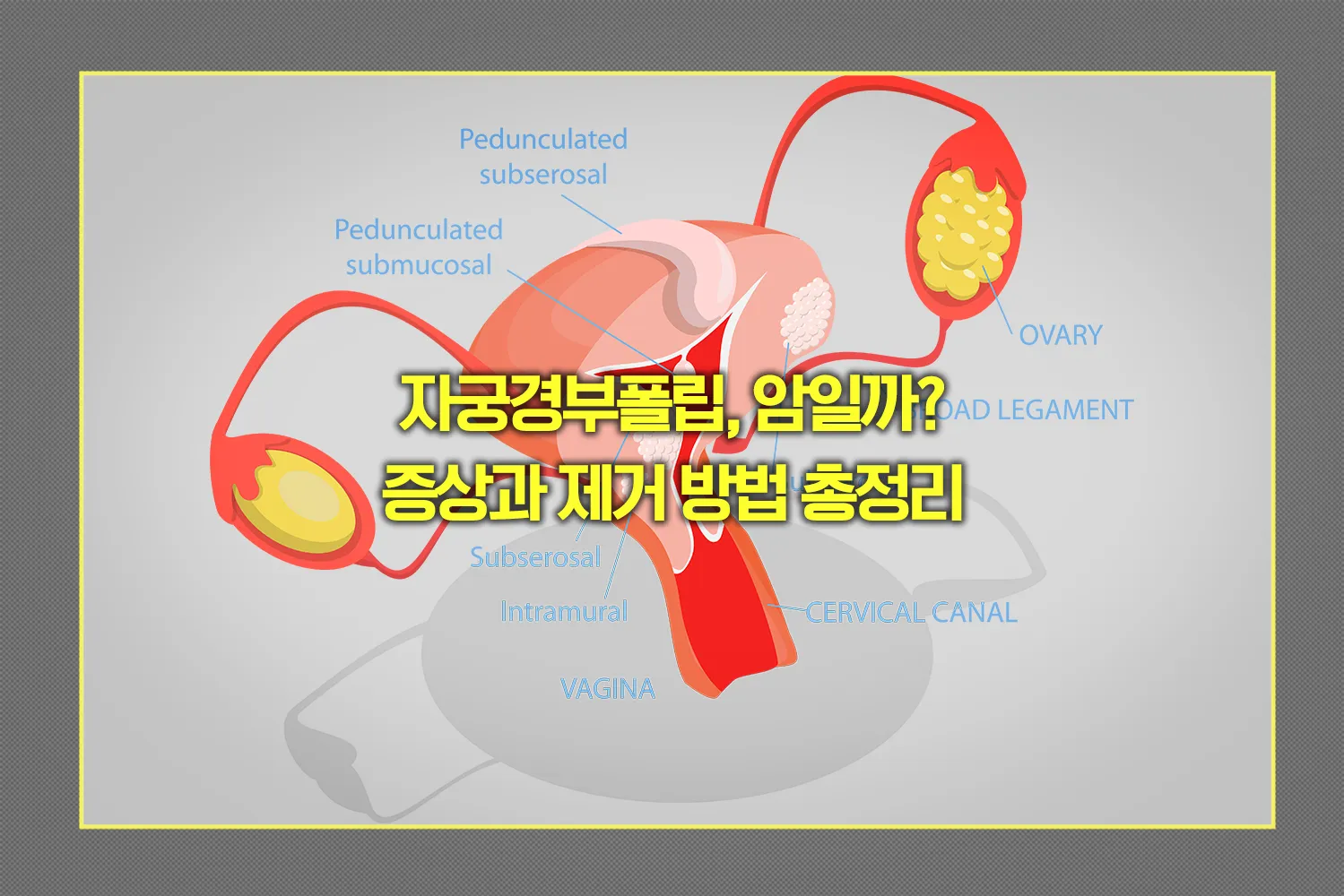 cervical-polyp-cancer-or-not