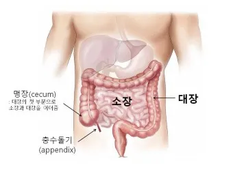 맹장 위치 남자 여자_11