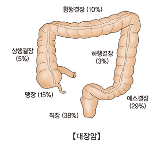대장암 초기 증상과 예방법