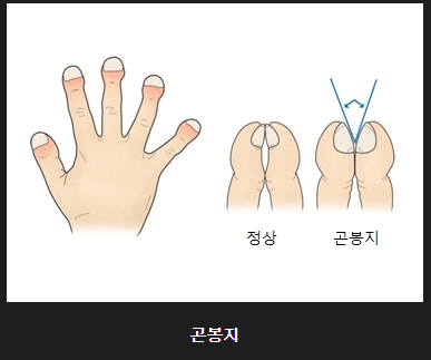 곤봉지검사-손가락