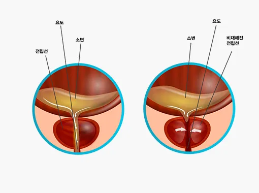 전립선비대증 치료약 부작용