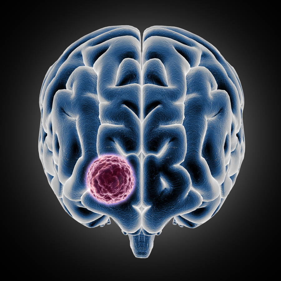 뇌에 발생한 뇌종양을 3D 이미지로 형상화를 한 사진(3d-medical-showing-brain-with-tumor-growing)