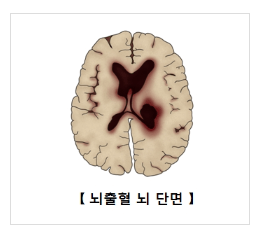 뇌출혈 뇌사진