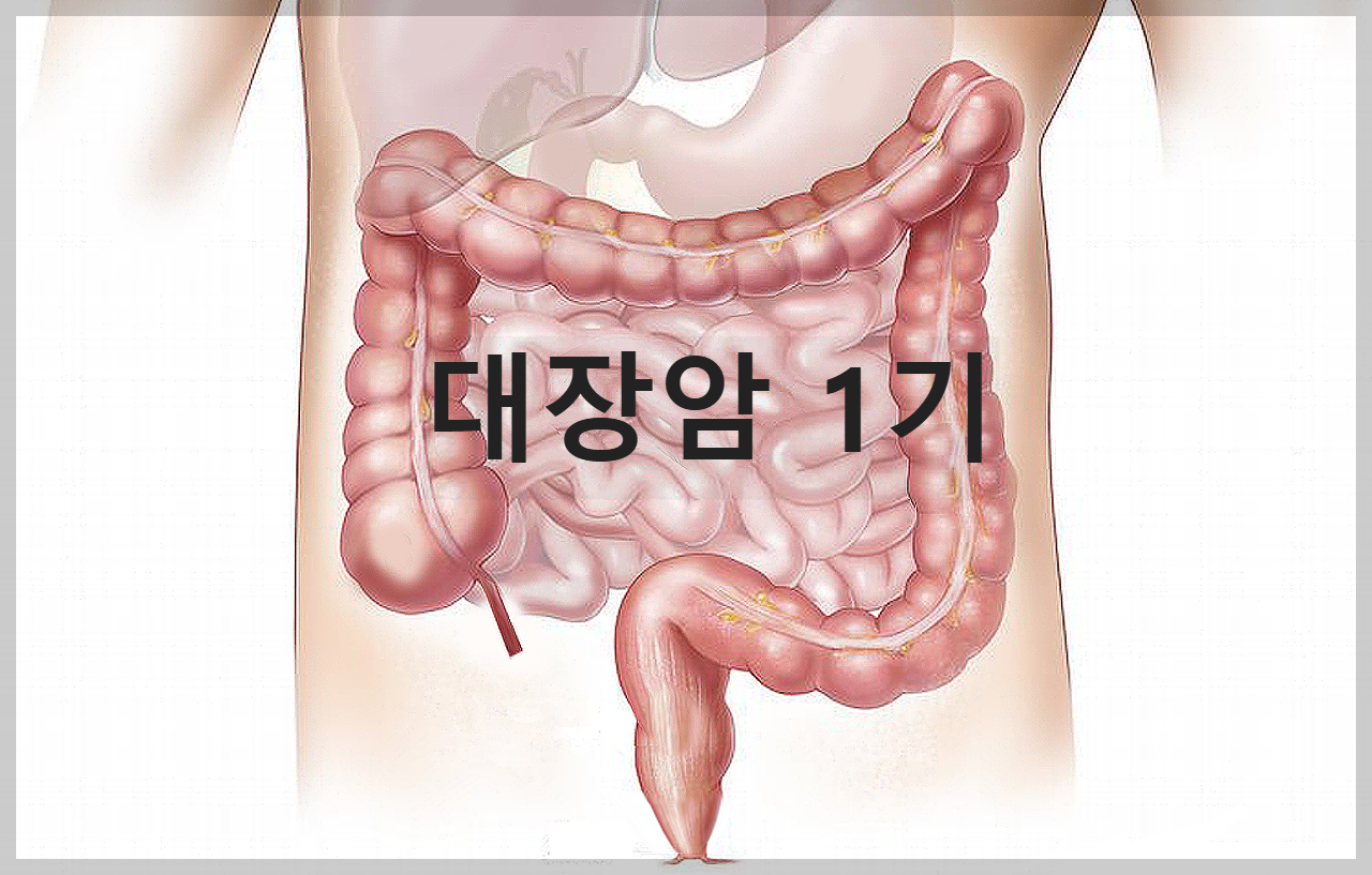 대장암 1기