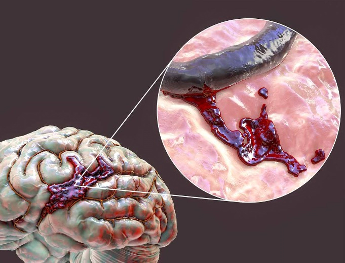 뇌출혈 초기증상 6가지 및 뇌출혈 수술 방법 및 후유증 총정리