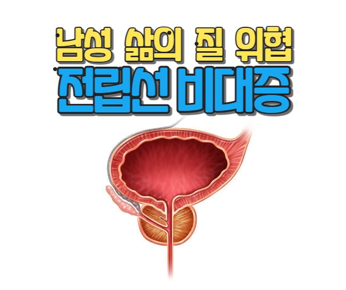  전립선비대증 예방법 알아보기