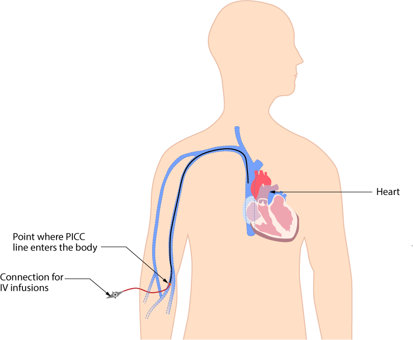 약물 적합성(compatibility) 확인을 위한 IV infusion set 구성, peripheral line과 central line의 차이, Lumen catheter - Central line vs peripheral line? - 📌 Central line 약물 적합성(compatibility) 확인을 위한 IV infusion set 구성, peripheral line과 central line의 차이, Lumen catheter - Central line vs peripheral line? - 📌 Central line