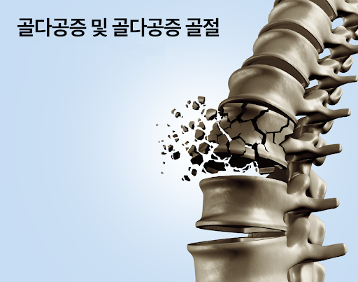  비타민D와 골다공증