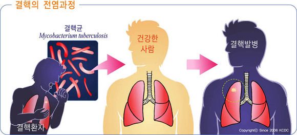 결핵 증상