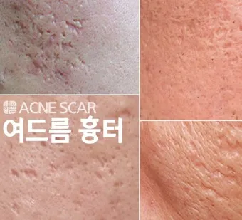 흉터전용 치료 추천 스카덤 겔 효능효과_9