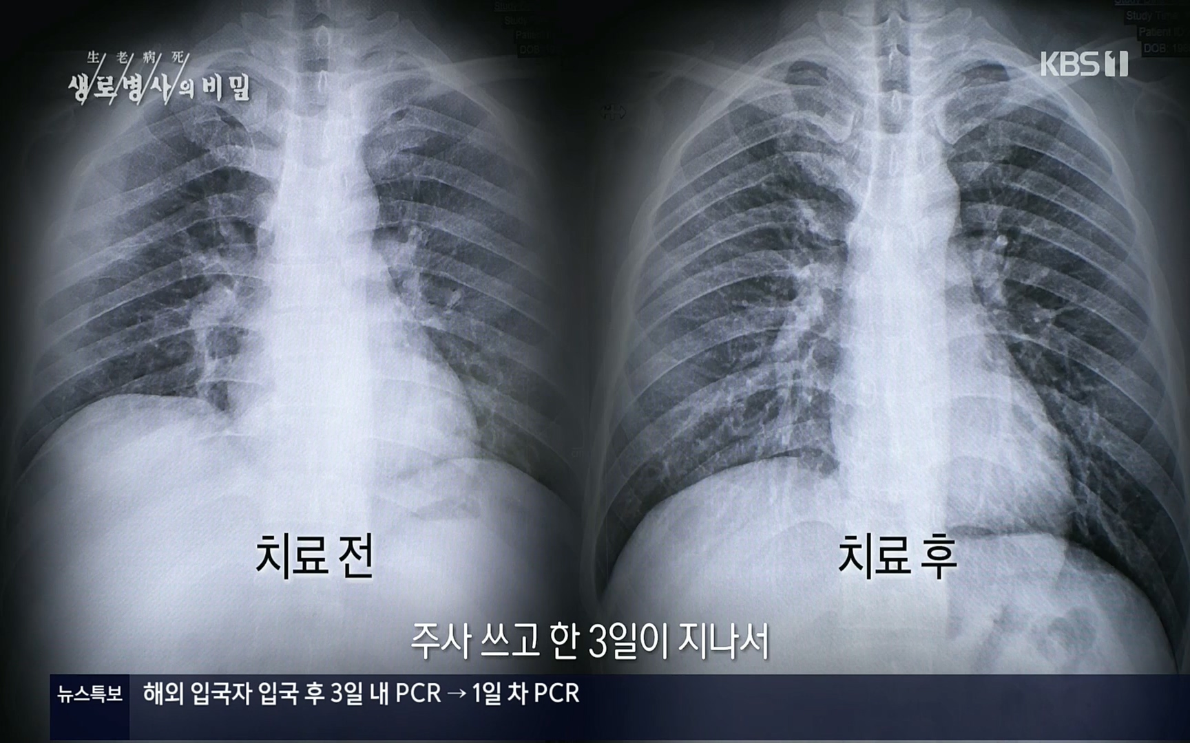 생로병사의 비밀.E826.220713p.H264-F1RST.mp4_20220714_183059.936.jpg