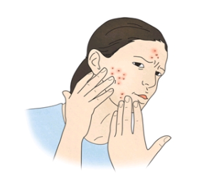  여드름 빨리 없애는 법/원인/증상/치료