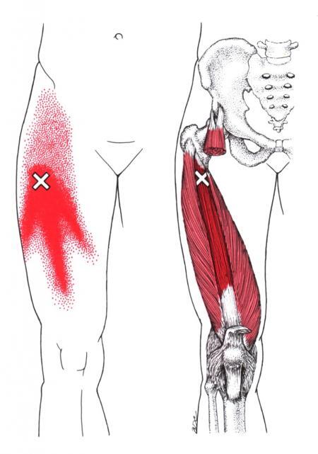 허벅지의 trigger point_중간광근