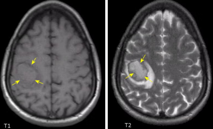초급성기 ICH의 T1WI &amp; T2WI 사진
출처 : https://case.edu/med/neurology/NR/Hyperacute%20ICH.html