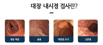 대장내시경 용종제거 후 식사 식단조절_26