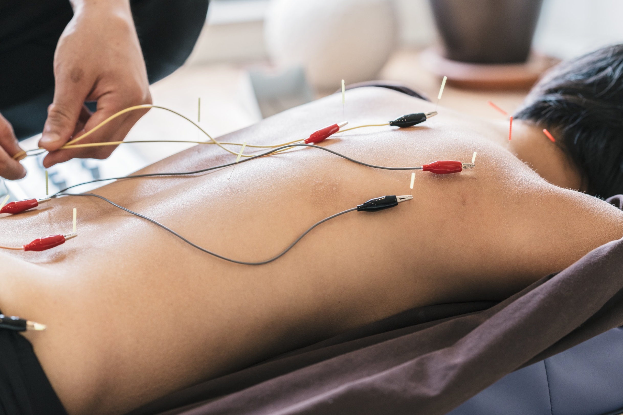  CHRONIC PAIN AND THE ROLE OF ELECTRIC ACUPUNCTURE