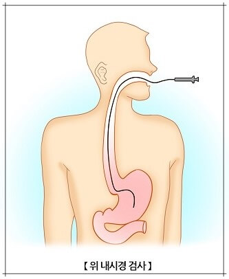 위 내시경 검사_설명사진