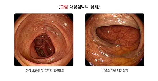 대장내시경 당일식사 주의사항 피해야 하는 음식_2
