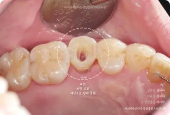 어금니 칫솔 사용법 선택방법 실사용 후기_4