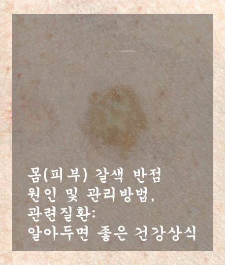  몸(피부) 갈색 반점 원인 및 관리방법, 관련질환: 알아두면 좋은 건강상식