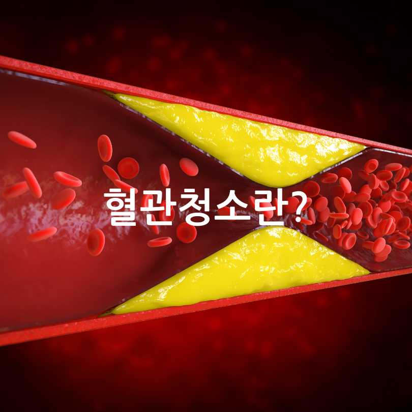 혈관청소하는 주사 : 킬레이션주사 가격과 효과