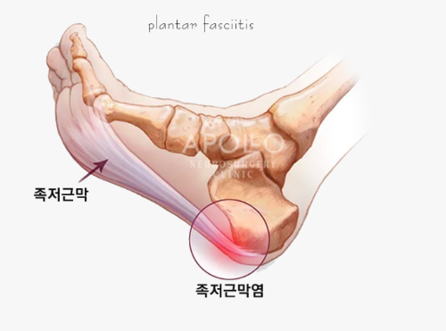 발바닥 근막염(족저근막염) 증상 및 치료법