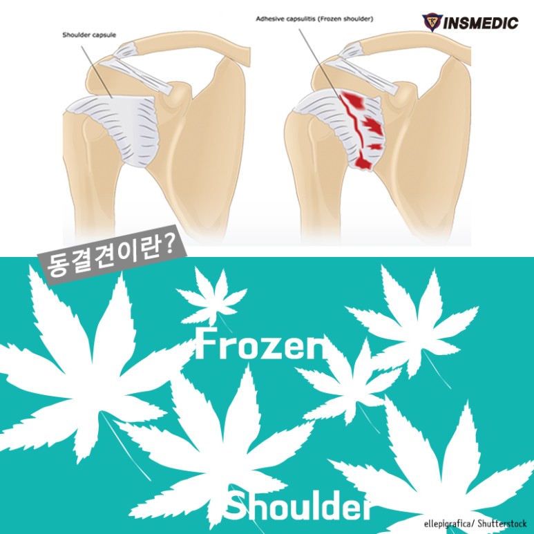 올바른 표현 동결견!! [국제 테이핑] 오십견의