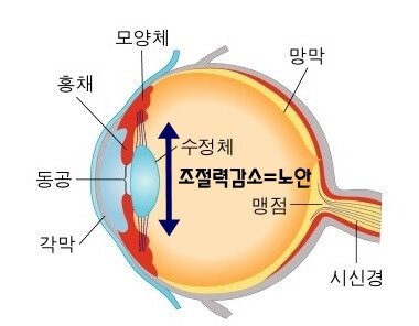 수정체조절력감소