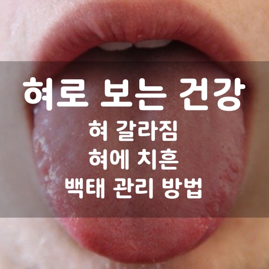  혀 갈라짐 이유? 혀로 보는 건강 상태, 혀 건강 백태 관리 팁 대방출