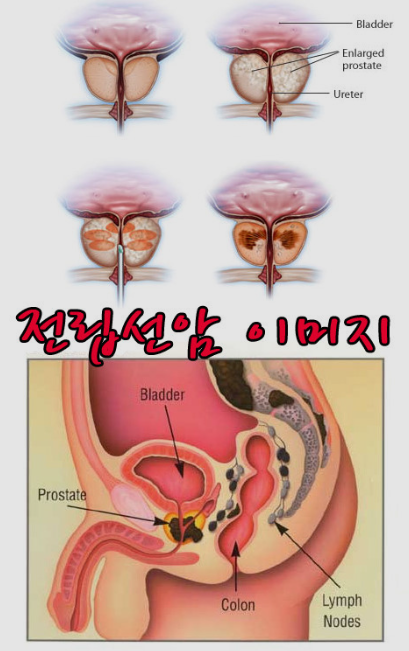  전립선암의 초기증상과 발병원인은?