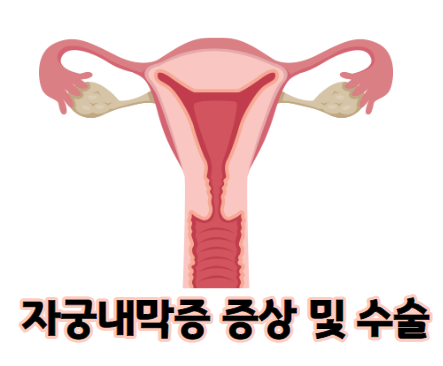 자궁내막증 증상 및 수술