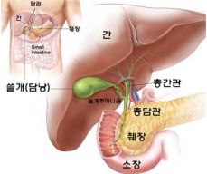 담낭염 증상