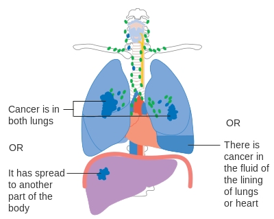 폐암이란 무엇인가요?2