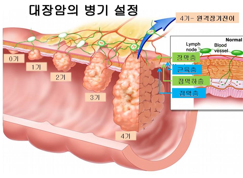  대장암 초기증상 총정리