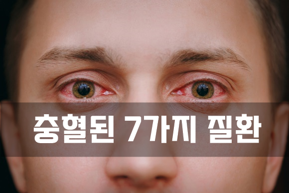  충혈된 눈이 경고하는 7가지 질환