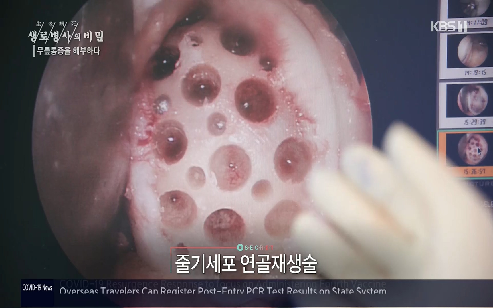 생로병사의 비밀.E834.220907p.H264-F1RST.mp4_20220908_210423.076.jpg