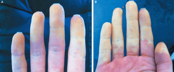 레이노증후군-손색깔