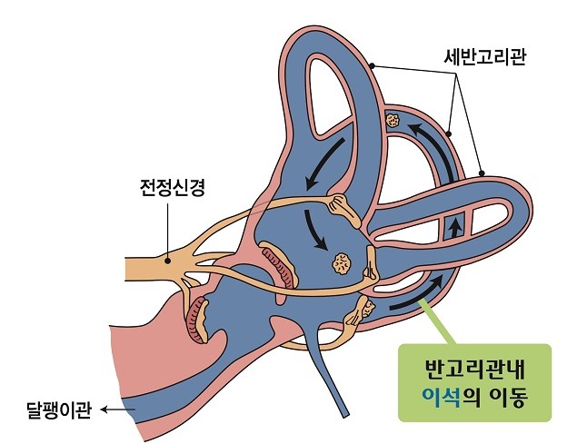 이석증