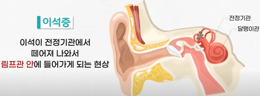 이석증 자가진단 자가치료 방법