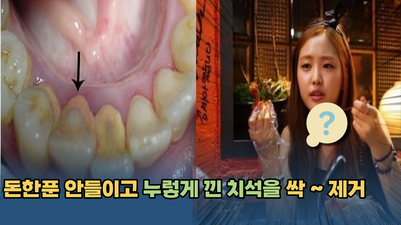  '효과 대박이네요.. ㅎㄷㄷ' 이것 하나면 누렇게 굳은 치석이 싹 사라집니다.