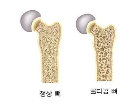  골절 위험도 자가진단