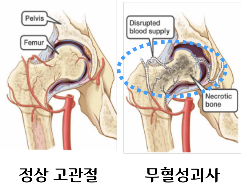 Avascular Necrosis&#44; AVN 무혈성괴사