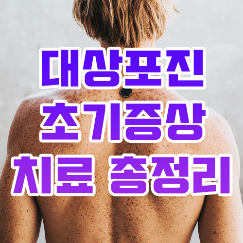  대상포진 초기증상 치료 총정리