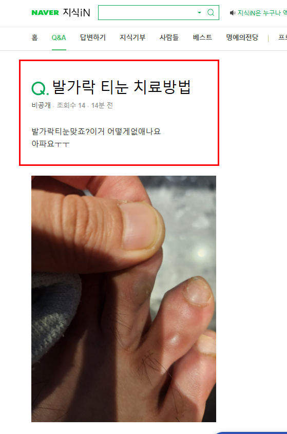 발가락 티눈 치료 질문