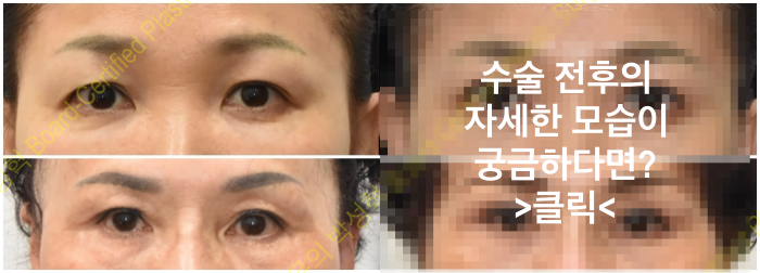 눈매교정