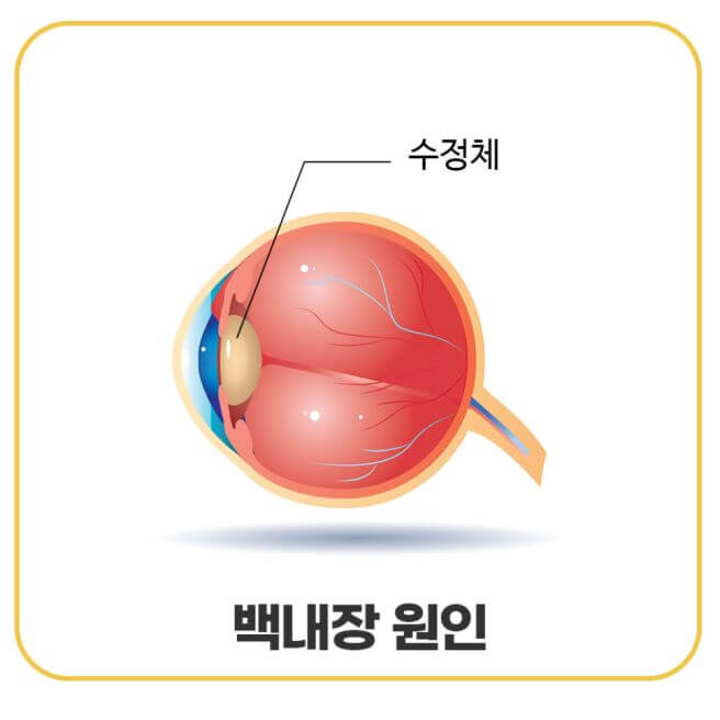 백내장 증상