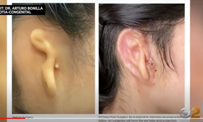 세계 최초 자신의 세포로 만든 3D 프린팅 귀 가져 VIDEO:Woman receives 3D-printed ear made of human cell