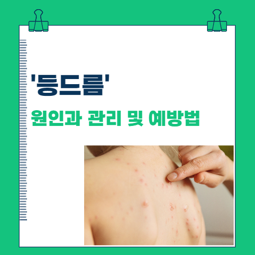  '등드름' 원인과 관리 및 예방법