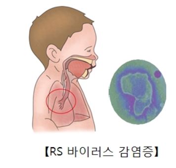  신생아 RSV 바이러스 감염 증상 치료법